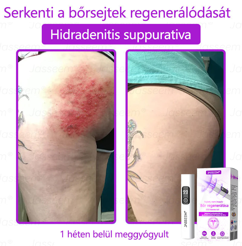 đđđŹđŹđđđŠÂź Fejlett, nem invazĂv bĆrjavĂtĂł COâ lĂ©zeres toll đ« (GyengĂ©den eltĂĄvolĂtja a szemölcsöket, anyajegyeket, öregsĂ©gi foltokat Ă©s bĆrkinövĂ©seket â fĂĄjdalom Ă©s gond nĂ©lkĂŒl!)