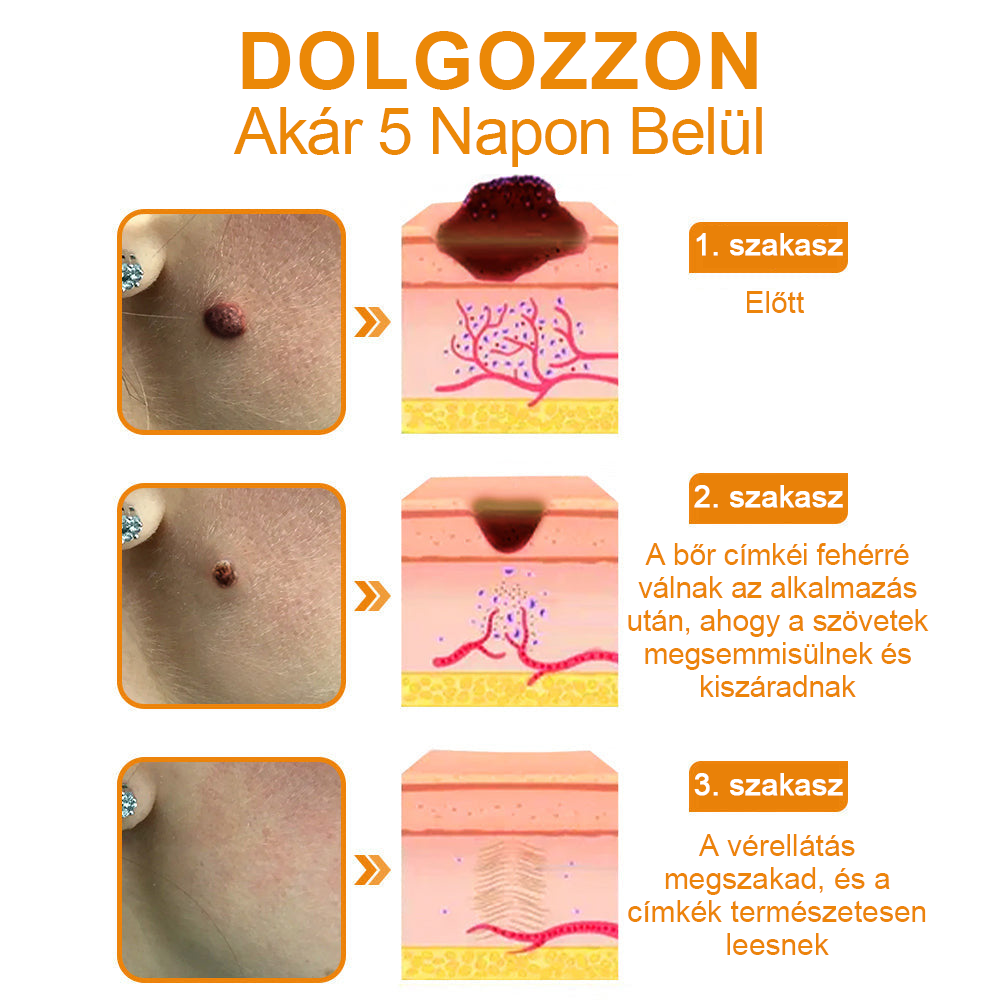 đ”ïžVsoxaâą mĂ©hmĂ©reg szemölcs Ă©s anyajegy eltĂĄvolĂtĂł krĂ©m (UtolsĂł napi akciĂł, 80% kedvezmĂ©ny)đ·