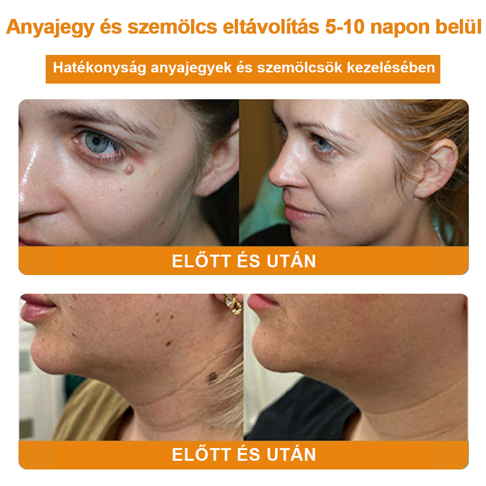 đ”ïžVsoxaâą mĂ©hmĂ©reg szemölcs Ă©s anyajegy eltĂĄvolĂtĂł krĂ©m (UtolsĂł napi akciĂł, 80% kedvezmĂ©ny)đ·