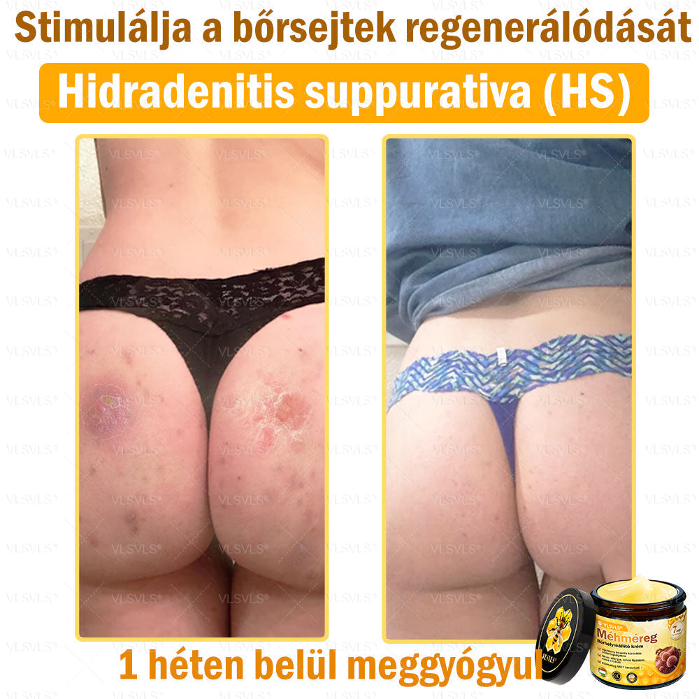 VLSVLS® Méhméreg Bőrhelyreállító Krém (👨⚕CE jóváhagyott)👍✅