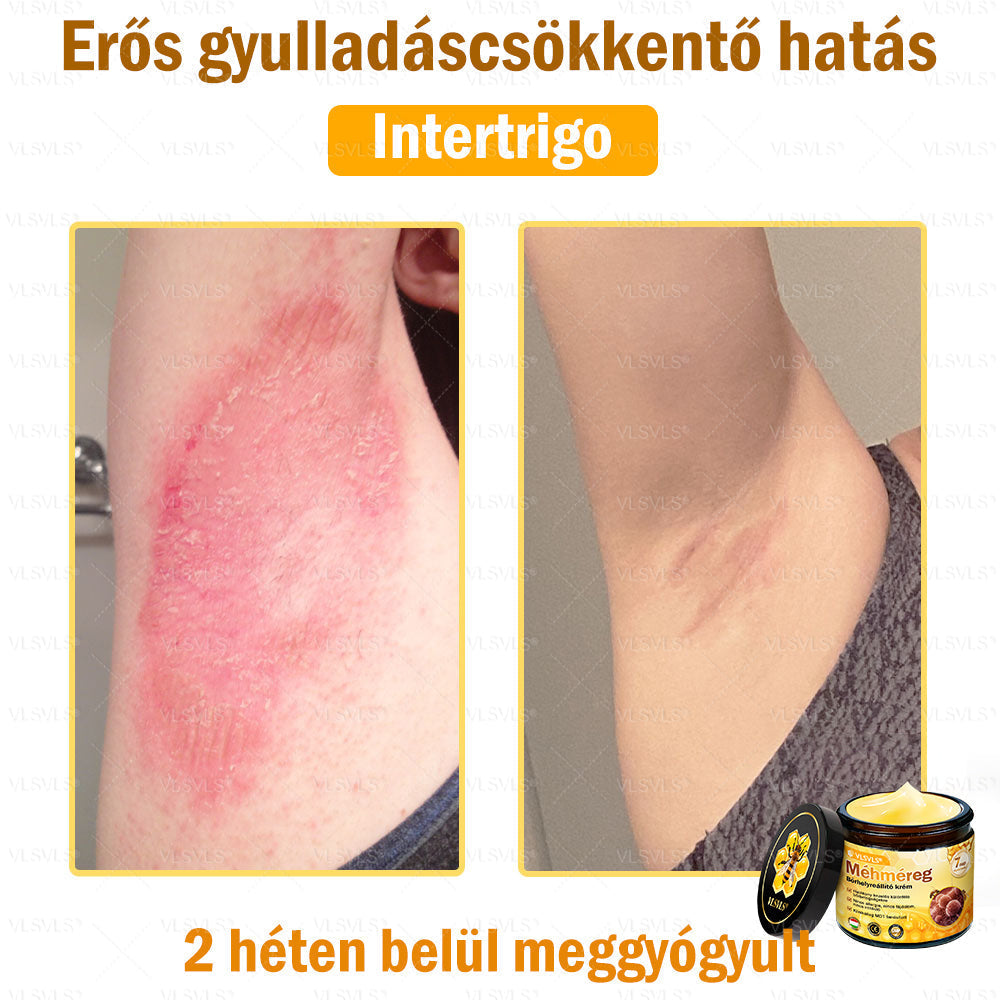 VLSVLS® Méhméreg Bőrhelyreállító Krém (👨⚕CE jóváhagyott)👍✅