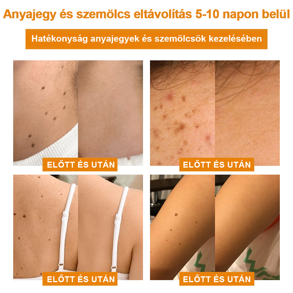 đ”ïžVsoxaâą mĂ©hmĂ©reg szemölcs Ă©s anyajegy eltĂĄvolĂtĂł krĂ©m (UtolsĂł napi akciĂł, 80% kedvezmĂ©ny)đ·