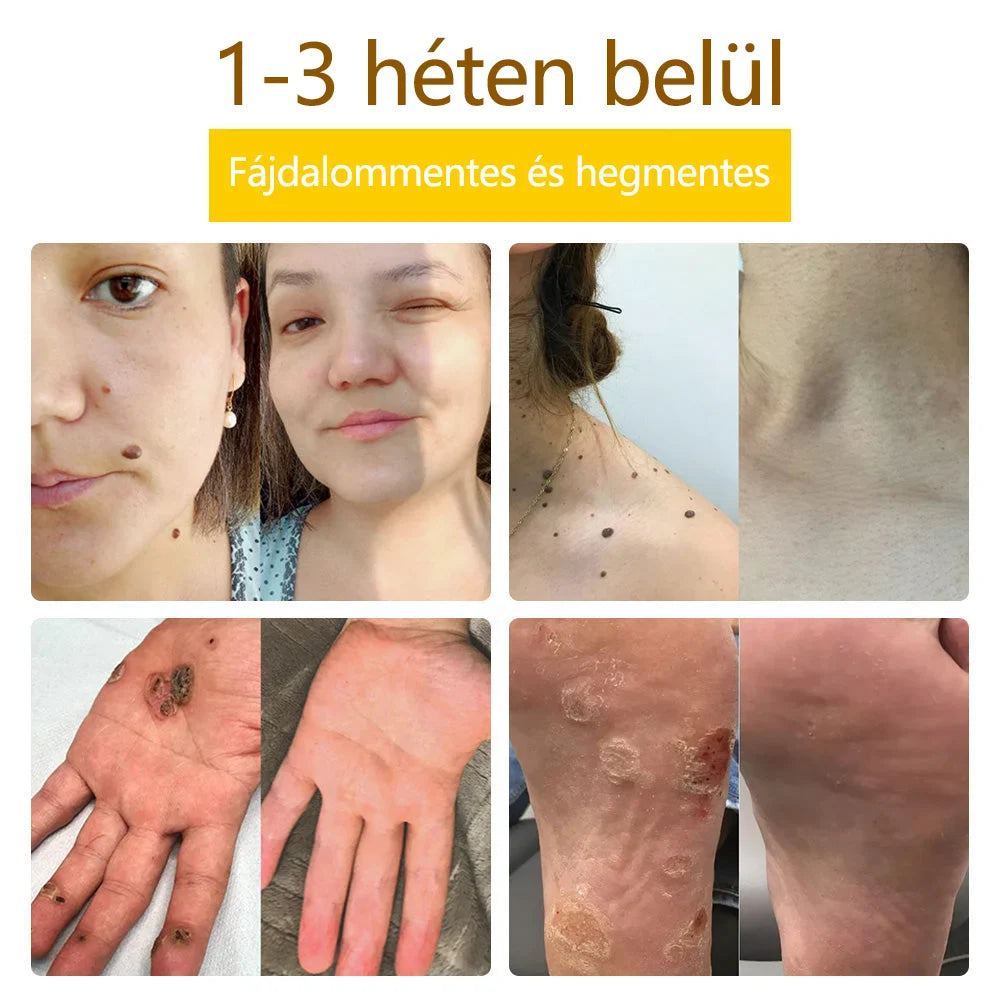 ✅flysmus™ méhméreg kezelő krém🐝: Ekcéma, pikkelysömör, akne, rosacea, gombás fertőzések, szemölcsök kezelése🐝🐝🐝