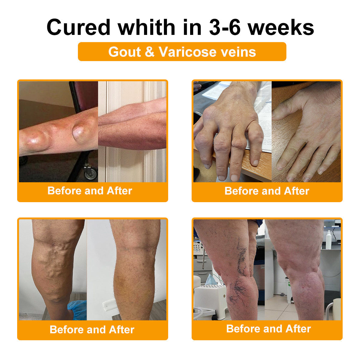 🦴TLOPA® Botulinum Toxin és Méhméreg Fájdalomcsillapító Csontgyógyító Krém🐝 🔥(Kifejezetten időseknek & ortopéd szakorvosok ajánlásával)🦴🦴🦴🦴🦴