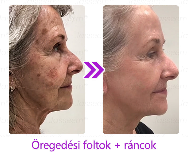 đđđŹđŹđđđŠÂź Fejlett, nem invazĂv bĆrjavĂtĂł COâ lĂ©zeres toll đ« (GyengĂ©den eltĂĄvolĂtja a szemölcsöket, anyajegyeket, öregsĂ©gi foltokat Ă©s bĆrkinövĂ©seket â fĂĄjdalom Ă©s gond nĂ©lkĂŒl!)