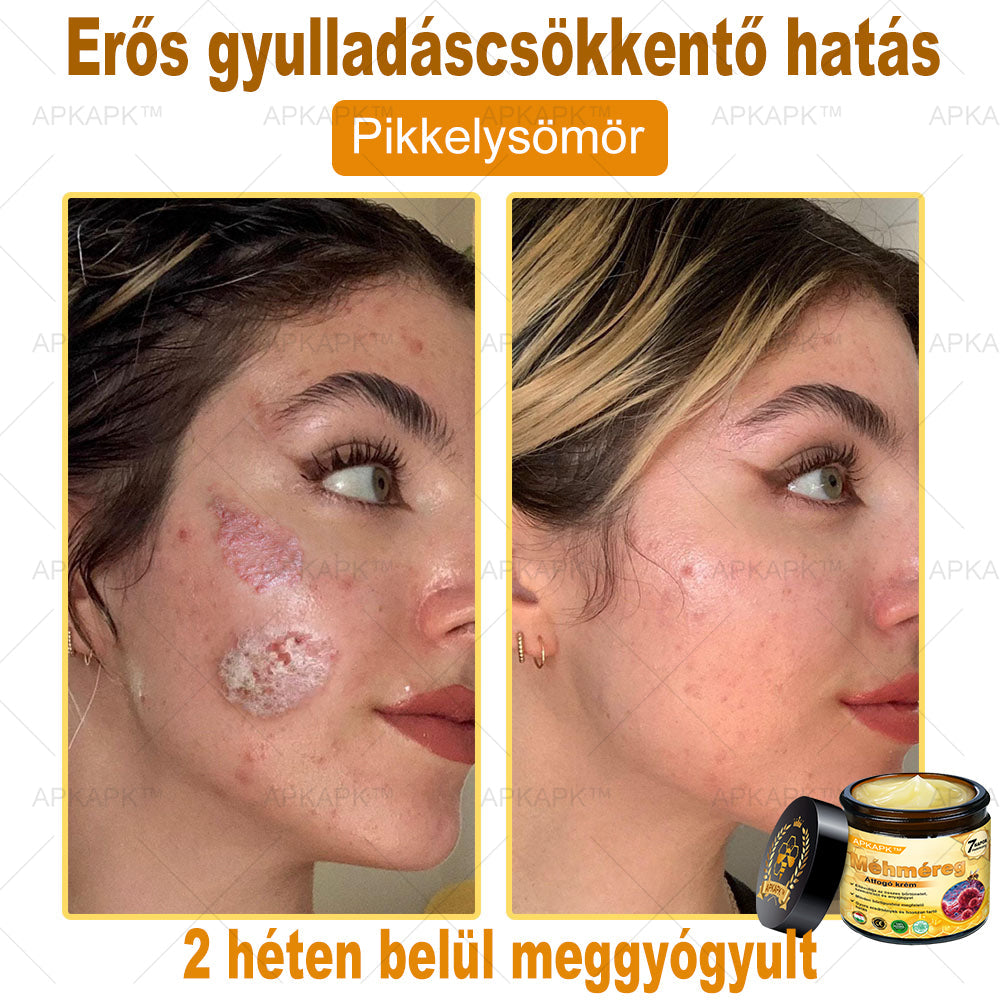𝐀𝐏𝐊𝐀𝐏𝐊™ 𝐌É𝐇𝐌É𝐑𝐄𝐆 Á𝐓𝐅𝐎𝐆Ó 𝐊𝐑É𝐌🥇🥇𝐀 𝐛ö𝐫𝐩𝐫𝐨𝐛𝐥é𝐦á𝐤 𝐤𝐞𝐳𝐞𝐥é𝐬𝐞 𝐦𝐚𝐠á𝐛𝐚𝐧 𝐟𝐨𝐠𝐥𝐚𝐥𝐣𝐚: é𝐥𝐞𝐭𝐤𝐨𝐫𝐢 𝐟𝐨𝐥𝐭𝐨𝐤, 𝐡𝐞𝐠𝐞𝐤, 𝐬𝐳𝐞𝐦ö𝐥𝐜𝐬ö𝐤, 𝐛ö𝐫𝐧ö𝐯𝐞𝐝é𝐤𝐞𝐤, 𝐭á𝐥𝐲𝐨𝐠𝐨𝐤, 𝐩𝐚𝐭𝐭𝐚𝐧á𝐬𝐨𝐤, 𝐞𝐤𝐜é𝐦𝐚, 𝐩𝐬𝐨𝐫𝐢𝐚𝐬𝐢𝐬, 𝐚𝐜𝐧𝐞 𝐢𝐧𝐯𝐞𝐫𝐬𝐚, 𝐫á𝐧𝐜𝐨𝐤, 𝐛ö𝐫ö𝐫𝐞𝐠𝐞𝐝é𝐬 é𝐬 𝐞𝐠𝐲é𝐛 𝐩𝐫𝐨𝐛𝐥é𝐦á𝐤🔥