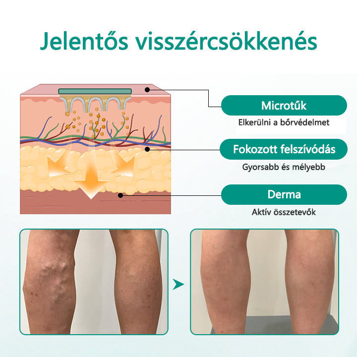 Cvreoz® LegRenew visszér tapasz javítja a vénák egészségét és megszünteti a visszereket🌿Nincs tű, nincs műtét, csak biztonságos, gyengéd és hatékony eredmény✨