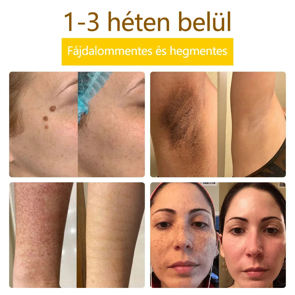 ✅flysmus™ méhméreg kezelő krém🐝: Ekcéma, pikkelysömör, akne, rosacea, gombás fertőzések, szemölcsök kezelése🐝🐝🐝