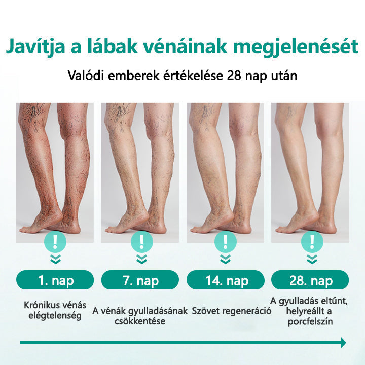 Cvreoz® LegRenew visszér tapasz javítja a vénák egészségét és megszünteti a visszereket🌿Nincs tű, nincs műtét, csak biztonságos, gyengéd és hatékony eredmény✨
