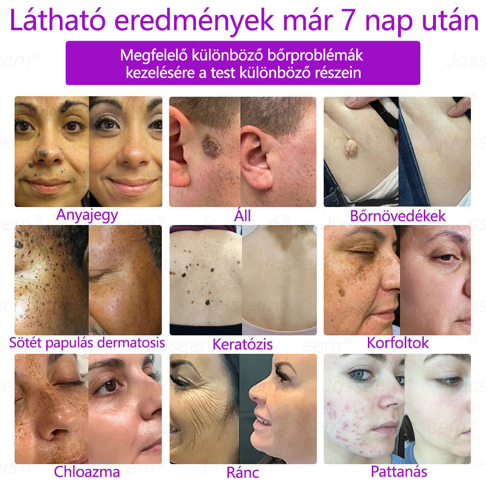 đđđŹđŹđđđŠÂź Fejlett, nem invazĂv bĆrjavĂtĂł COâ lĂ©zeres toll đ« (GyengĂ©den eltĂĄvolĂtja a szemölcsöket, anyajegyeket, öregsĂ©gi foltokat Ă©s bĆrkinövĂ©seket â fĂĄjdalom Ă©s gond nĂ©lkĂŒl!)