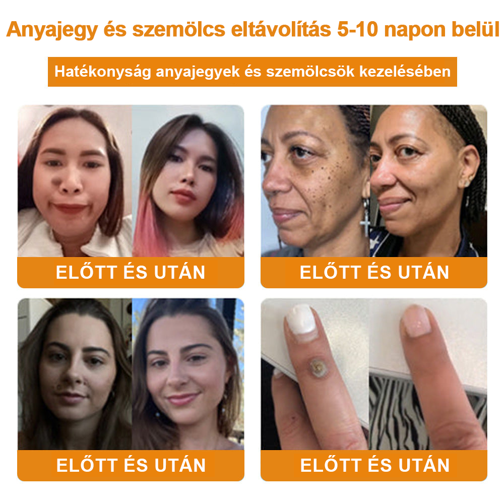 đ”ïžVsoxaâą mĂ©hmĂ©reg szemölcs Ă©s anyajegy eltĂĄvolĂtĂł krĂ©m (UtolsĂł napi akciĂł, 80% kedvezmĂ©ny)đ·