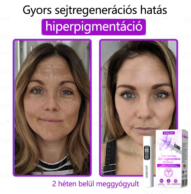 đđđŹđŹđđđŠÂź Fejlett, nem invazĂv bĆrjavĂtĂł COâ lĂ©zeres toll đ« (GyengĂ©den eltĂĄvolĂtja a szemölcsöket, anyajegyeket, öregsĂ©gi foltokat Ă©s bĆrkinövĂ©seket â fĂĄjdalom Ă©s gond nĂ©lkĂŒl!)