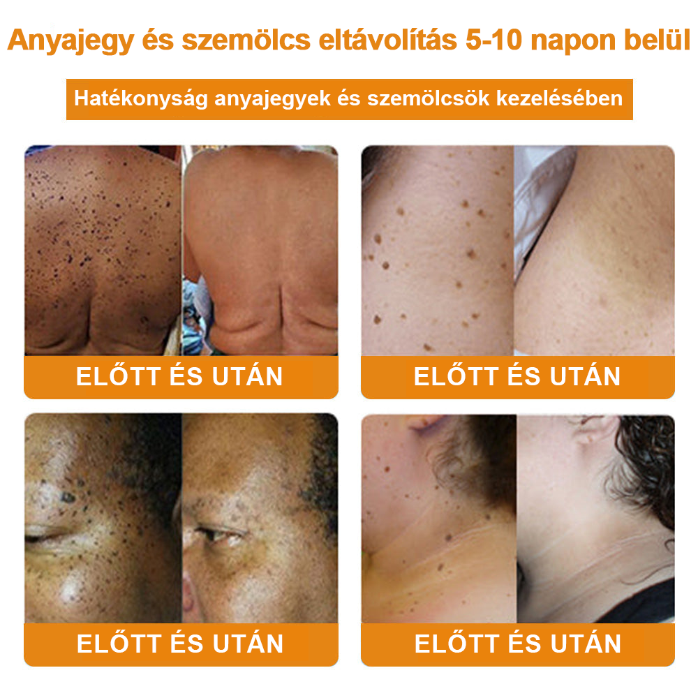 đ”ïžVsoxaâą mĂ©hmĂ©reg szemölcs Ă©s anyajegy eltĂĄvolĂtĂł krĂ©m (UtolsĂł napi akciĂł, 80% kedvezmĂ©ny)đ·
