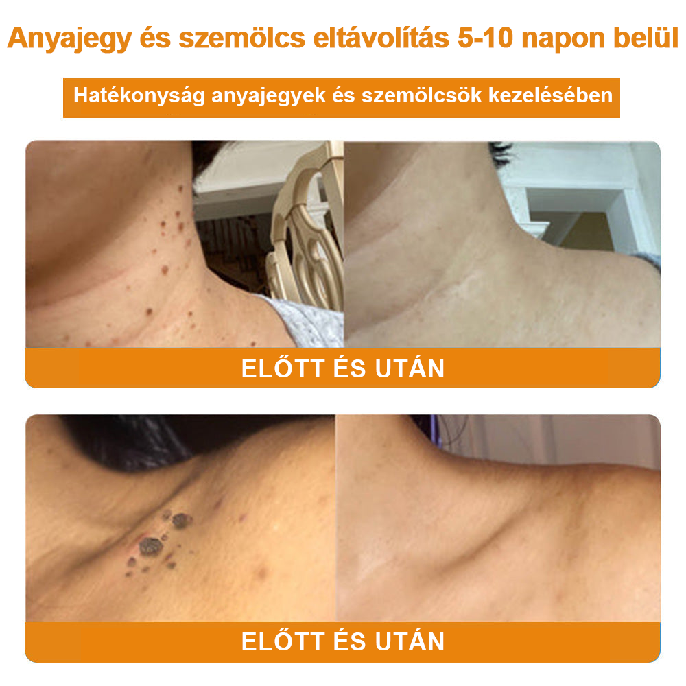 đ”ïžVsoxaâą mĂ©hmĂ©reg szemölcs Ă©s anyajegy eltĂĄvolĂtĂł krĂ©m (UtolsĂł napi akciĂł, 80% kedvezmĂ©ny)đ·