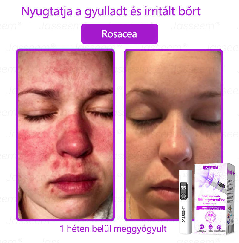 đđđŹđŹđđđŠÂź Fejlett, nem invazĂv bĆrjavĂtĂł COâ lĂ©zeres toll đ« (GyengĂ©den eltĂĄvolĂtja a szemölcsöket, anyajegyeket, öregsĂ©gi foltokat Ă©s bĆrkinövĂ©seket â fĂĄjdalom Ă©s gond nĂ©lkĂŒl!)