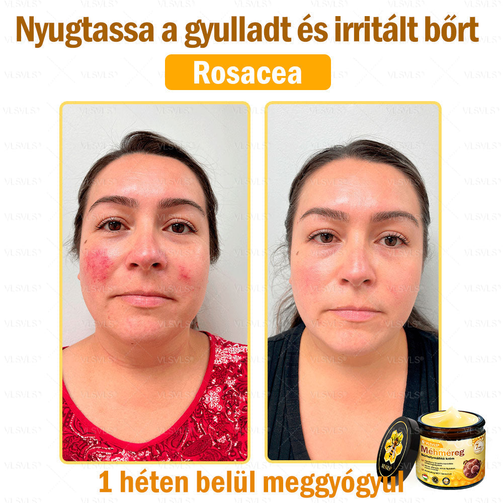VLSVLS® Méhméreg Bőrhelyreállító Krém (👨⚕CE jóváhagyott)👍✅
