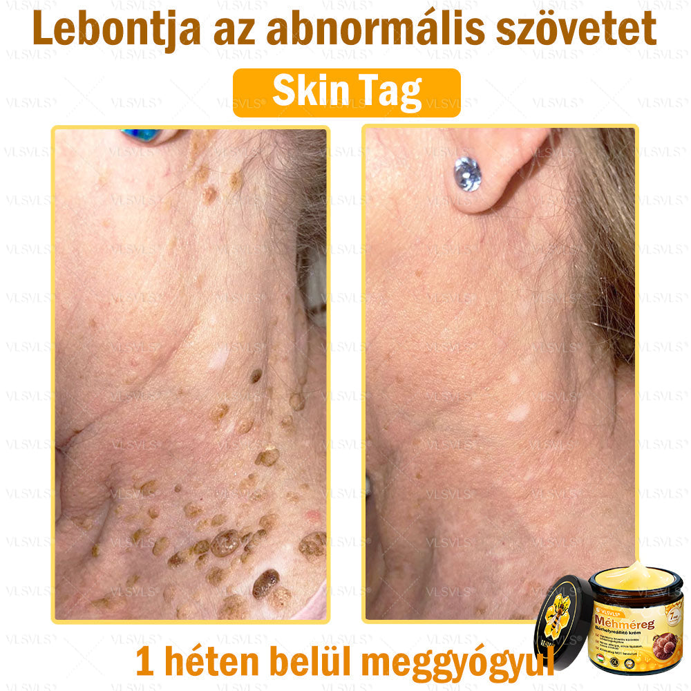 VLSVLS® Méhméreg Bőrhelyreállító Krém (👨⚕CE jóváhagyott)👍✅