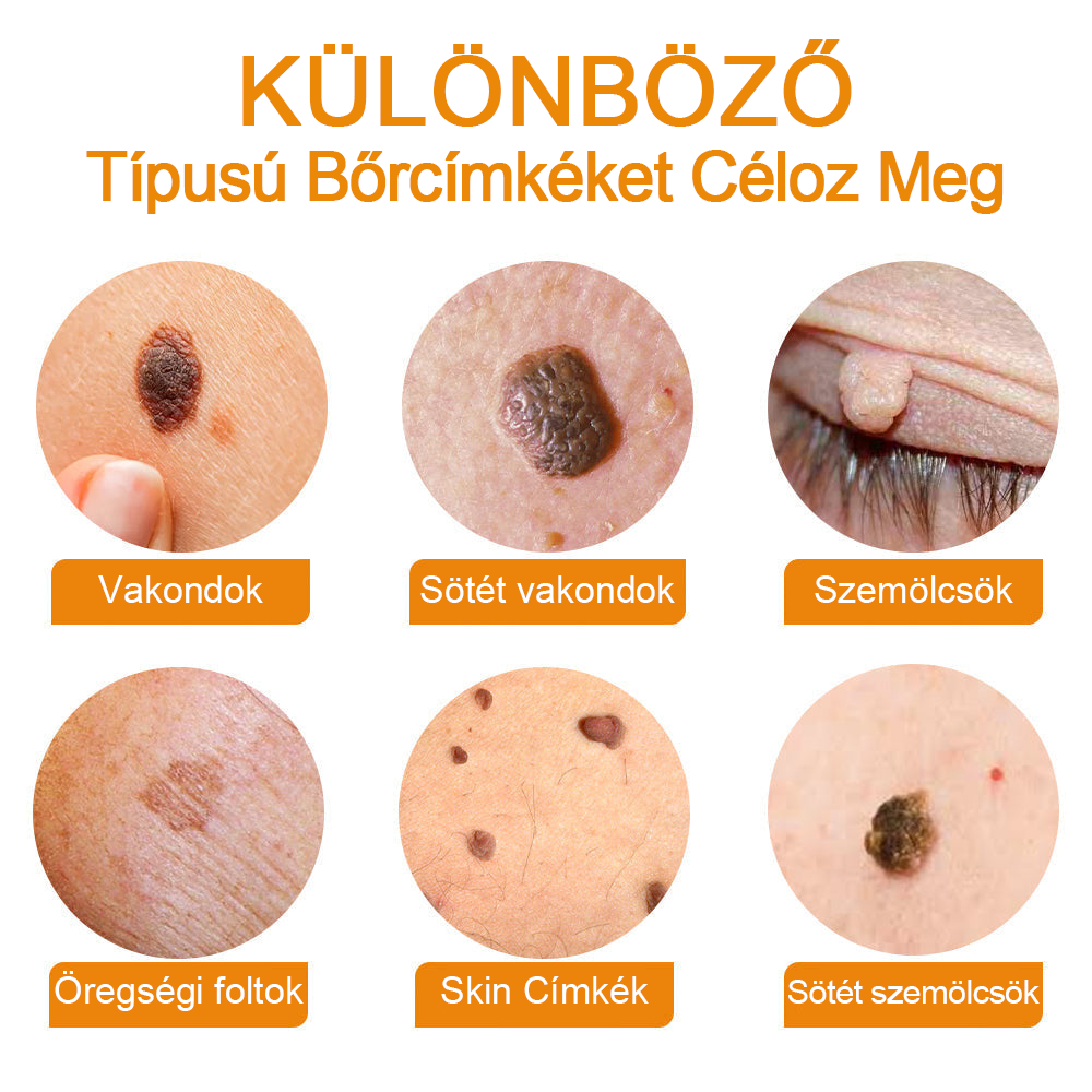 đ”ïžVsoxaâą mĂ©hmĂ©reg szemölcs Ă©s anyajegy eltĂĄvolĂtĂł krĂ©m (UtolsĂł napi akciĂł, 80% kedvezmĂ©ny)đ·
