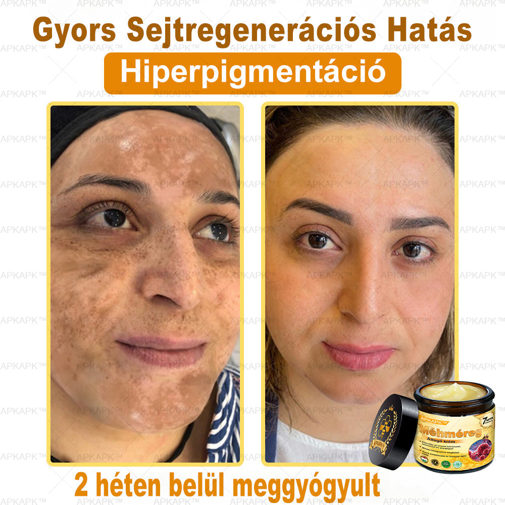 𝐀𝐏𝐊𝐀𝐏𝐊™ 𝐌É𝐇𝐌É𝐑𝐄𝐆 Á𝐓𝐅𝐎𝐆Ó 𝐊𝐑É𝐌🥇🥇𝐀 𝐛ö𝐫𝐩𝐫𝐨𝐛𝐥é𝐦á𝐤 𝐤𝐞𝐳𝐞𝐥é𝐬𝐞 𝐦𝐚𝐠á𝐛𝐚𝐧 𝐟𝐨𝐠𝐥𝐚𝐥𝐣𝐚: é𝐥𝐞𝐭𝐤𝐨𝐫𝐢 𝐟𝐨𝐥𝐭𝐨𝐤, 𝐡𝐞𝐠𝐞𝐤, 𝐬𝐳𝐞𝐦ö𝐥𝐜𝐬ö𝐤, 𝐛ö𝐫𝐧ö𝐯𝐞𝐝é𝐤𝐞𝐤, 𝐭á𝐥𝐲𝐨𝐠𝐨𝐤, 𝐩𝐚𝐭𝐭𝐚𝐧á𝐬𝐨𝐤, 𝐞𝐤𝐜é𝐦𝐚, 𝐩𝐬𝐨𝐫𝐢𝐚𝐬𝐢𝐬, 𝐚𝐜𝐧𝐞 𝐢𝐧𝐯𝐞𝐫𝐬𝐚, 𝐫á𝐧𝐜𝐨𝐤, 𝐛ö𝐫ö𝐫𝐞𝐠𝐞𝐝é𝐬 é𝐬 𝐞𝐠𝐲é𝐛 𝐩𝐫𝐨𝐛𝐥é𝐦á𝐤🔥