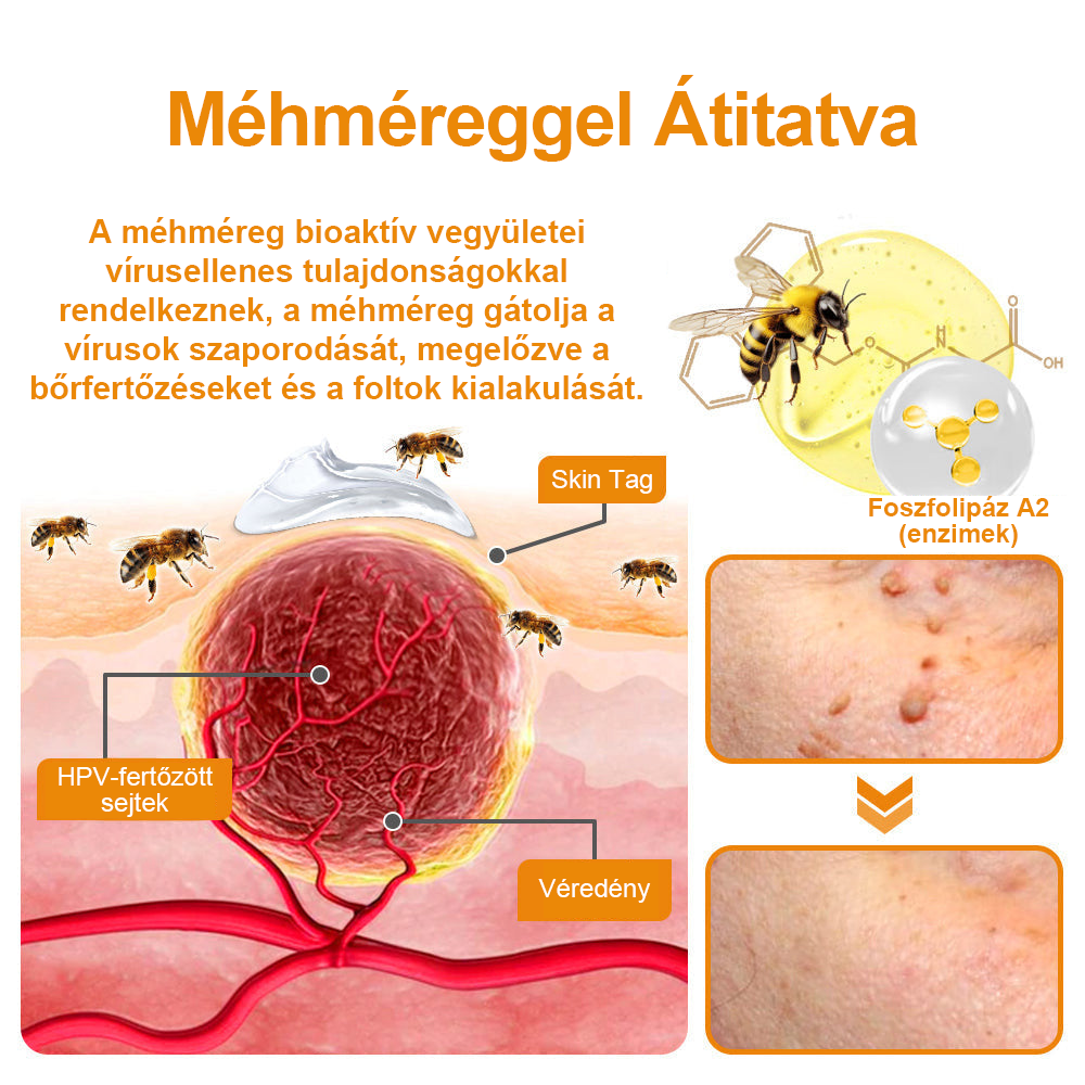 đ”ïžVsoxaâą mĂ©hmĂ©reg szemölcs Ă©s anyajegy eltĂĄvolĂtĂł krĂ©m (UtolsĂł napi akciĂł, 80% kedvezmĂ©ny)đ·