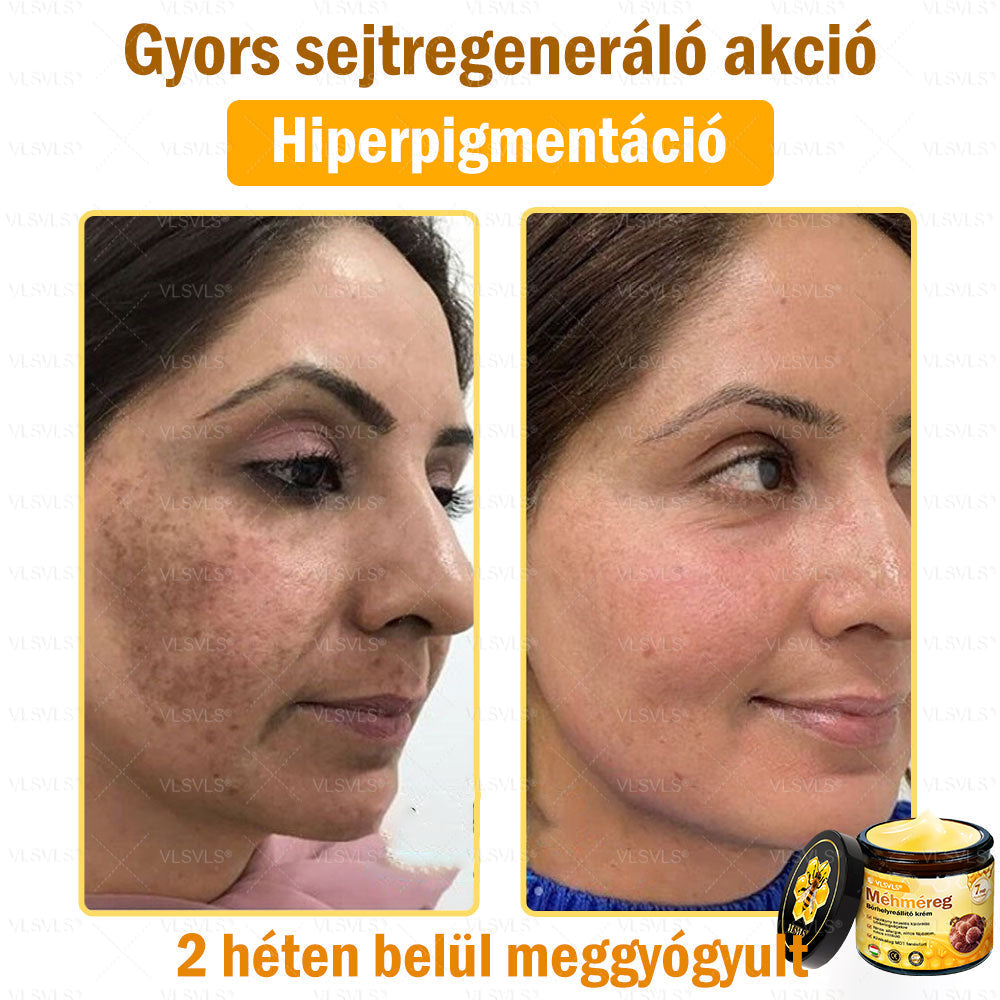 VLSVLS® Méhméreg Bőrhelyreállító Krém (👨⚕CE jóváhagyott)👍✅