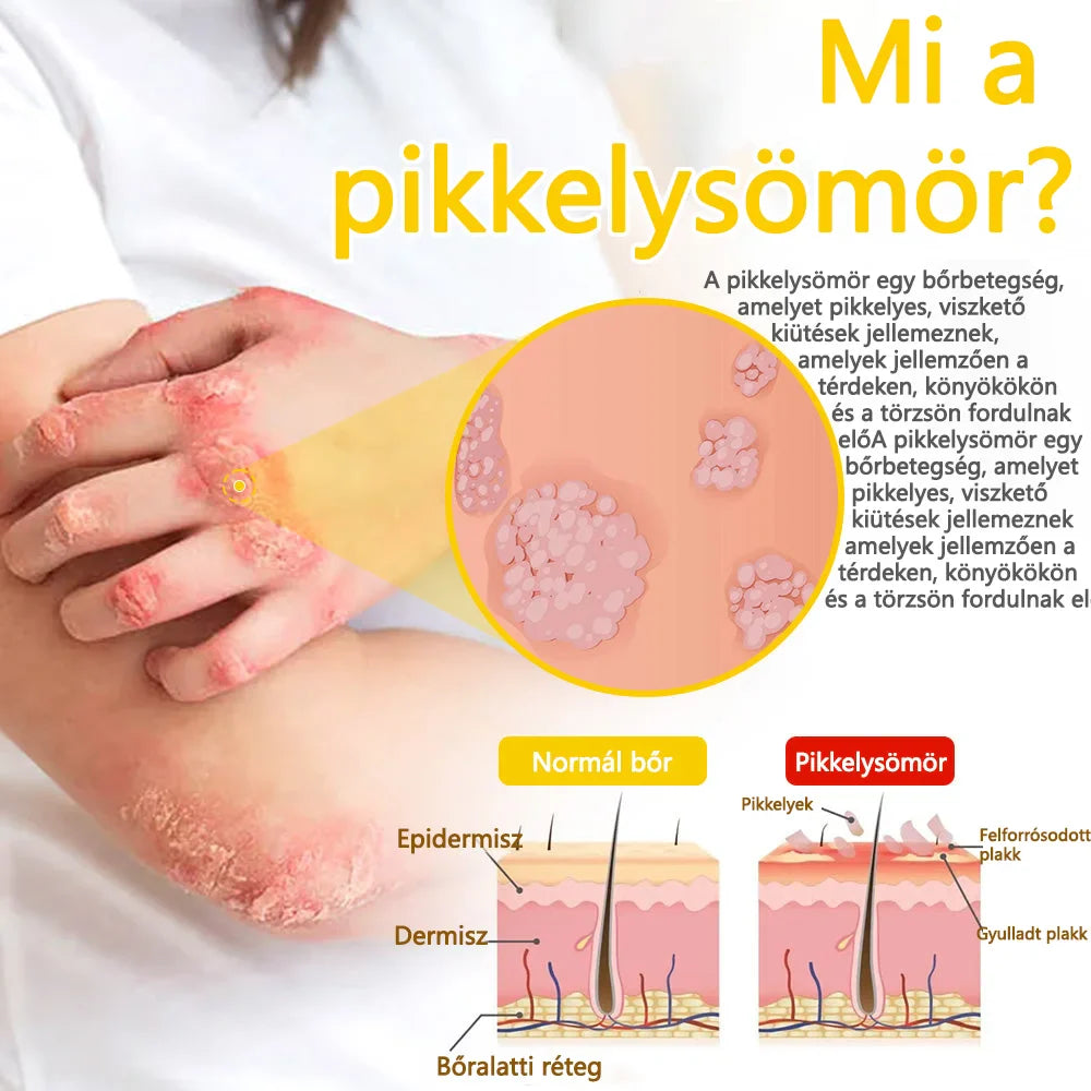 ✅flysmus™ méhméreg kezelő krém🐝: Ekcéma, pikkelysömör, akne, rosacea, gombás fertőzések, szemölcsök kezelése🐝🐝🐝