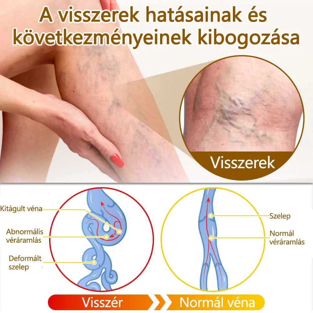 ✅flysmus™ méhméreg kezelő krém🐝: Ekcéma, pikkelysömör, akne, rosacea, gombás fertőzések, szemölcsök kezelése🐝🐝🐝