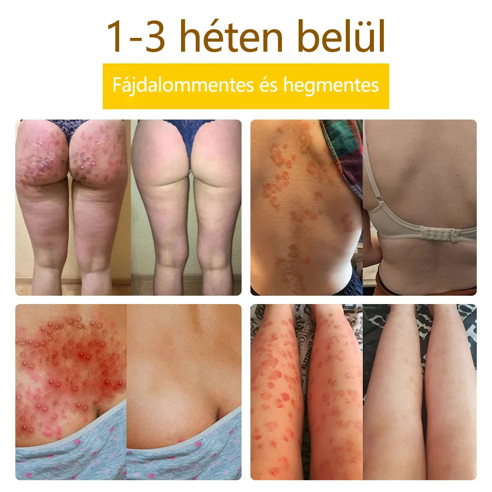 ✅flysmus™ méhméreg kezelő krém🐝: Ekcéma, pikkelysömör, akne, rosacea, gombás fertőzések, szemölcsök kezelése🐝🐝🐝