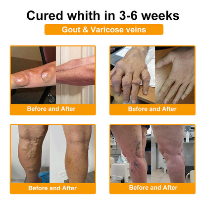 🦴TLOPA® Botulinum Toxin és Méhméreg Fájdalomcsillapító Csontgyógyító Krém🐝 🔥(Kifejezetten időseknek & ortopéd szakorvosok ajánlásával)🦴🦴🦴🦴🦴