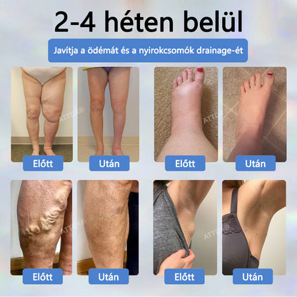 Cvreoz® Fekete kömény Ödéma méregtelenítő gyógynövénykrém - a gyors, látható enyhülés érdekében🍃🍃🍃