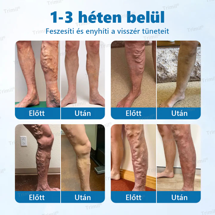 💚💚Trimil® VeinGuard Gyógynövényes Spray - ✅ Klinikailag bizonyított, hogy mindössze 7 nap alatt megszünteti a visszereket!💚💚💚