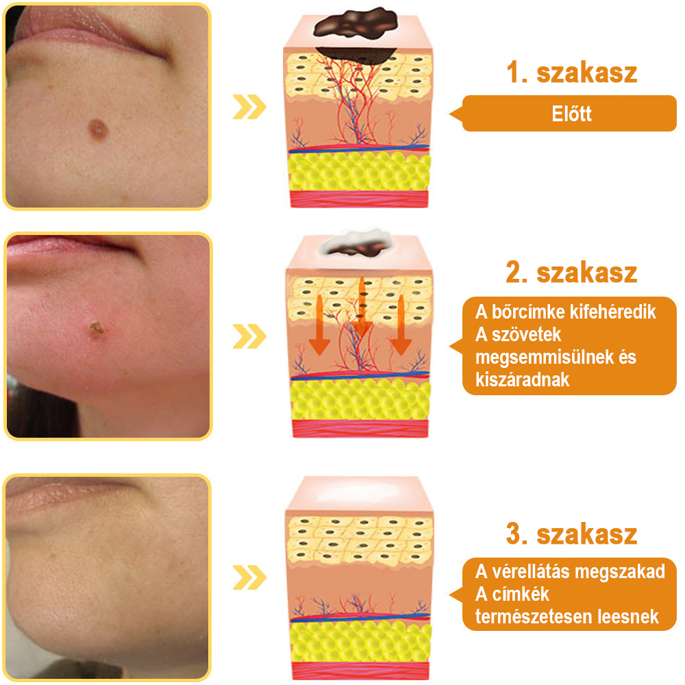 [💗utánvétel (COD)💗] Flysmus™Méhméreg szemölcs és övsömör eltávolító spray (👨‍⚕AAD Ajánlott) 🐝🐝(🔥Last Day 80% Off)🔥