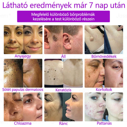𝐉𝐚𝐬𝐬𝐞𝐞𝐦® Fejlett, nem invazív bőrjavító CO₂ lézeres toll 🛫 (Gyengéden eltávolítja a szemölcsöket, anyajegyeket, öregségi foltokat és bőrkinövéseket – fájdalom és gond nélkül!)