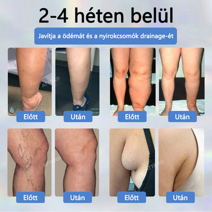 Cvreoz® Fekete kömény Ödéma méregtelenítő gyógynövénykrém - a gyors, látható enyhülés érdekében🍃🍃🍃