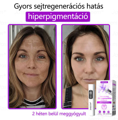 𝐉𝐚𝐬𝐬𝐞𝐞𝐦® Fejlett, nem invazív bőrjavító CO₂ lézeres toll 🛫 (Gyengéden eltávolítja a szemölcsöket, anyajegyeket, öregségi foltokat és bőrkinövéseket – fájdalom és gond nélkül!)