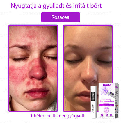 𝐉𝐚𝐬𝐬𝐞𝐞𝐦® Fejlett, nem invazív bőrjavító CO₂ lézeres toll 🛫 (Gyengéden eltávolítja a szemölcsöket, anyajegyeket, öregségi foltokat és bőrkinövéseket – fájdalom és gond nélkül!)