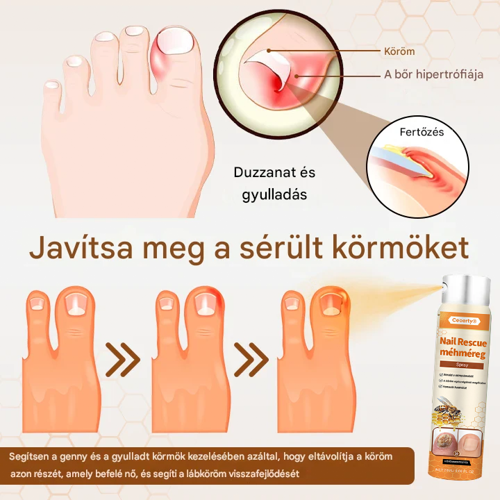 💥 2025 Korlátozott 70% KEDVEZMÉNY ️⏳ Ceoerty® NailRescue Kolirin méhméreg körömgomba spray 💥 Minden körömproblémát orvosolhatsz 2 héten belül👣👣👣