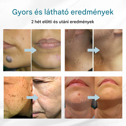 🔥Bikenda® non-invazív anyajegy- és szemölcseltávolító lézertoll🔥🔥🔥🔥