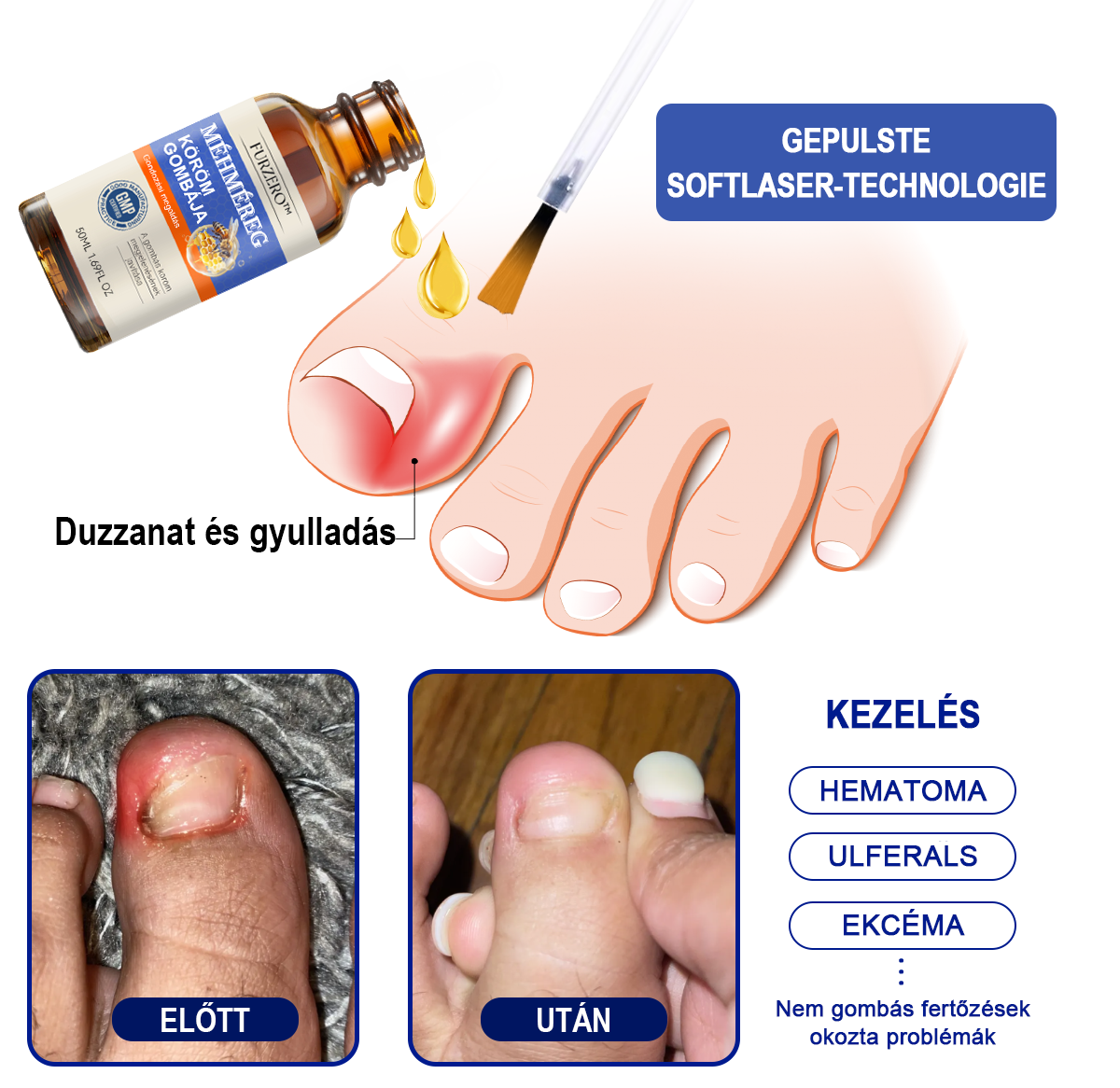 👣🐝🐝Furzero™ Méhméreg Körömgomba Kezelőoldat: Teljes megoldás a körömgomba problémájára🌟👣🐝👣