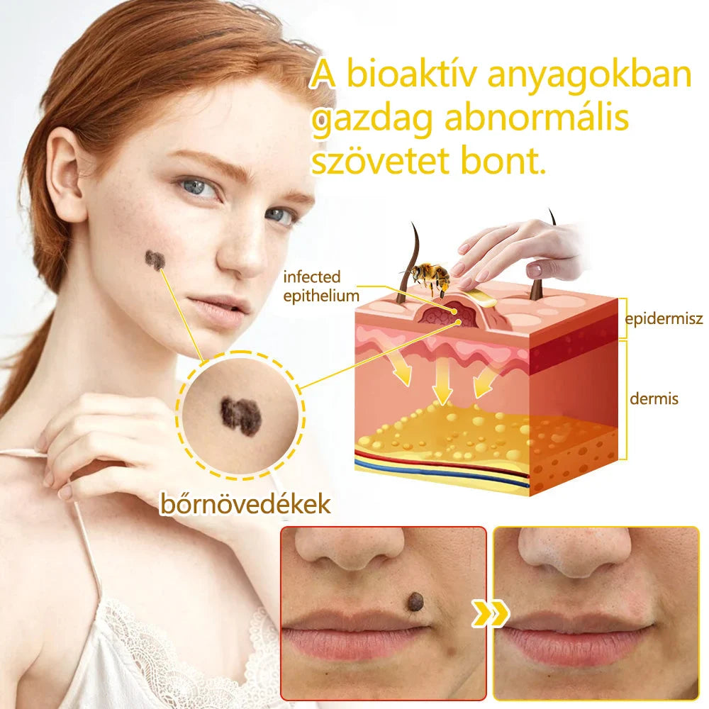 ✅flysmus™ méhméreg kezelő krém🐝: Ekcéma, pikkelysömör, akne, rosacea, gombás fertőzések, szemölcsök kezelése🐝🐝🐝