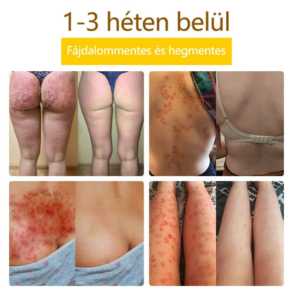 ✅flysmus™ méhméreg kezelő krém🐝: Ekcéma, pikkelysömör, akne, rosacea, gombás fertőzések, szemölcsök kezelése🐝🐝🐝